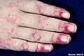 Dermatomyositis