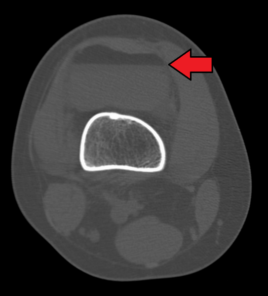 File:LipohemarthrosisCTMark.png