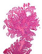 Micrograph of a Peutz–Jeghers colonic polyp – a type of hamartomatous polyp. H&E stain.