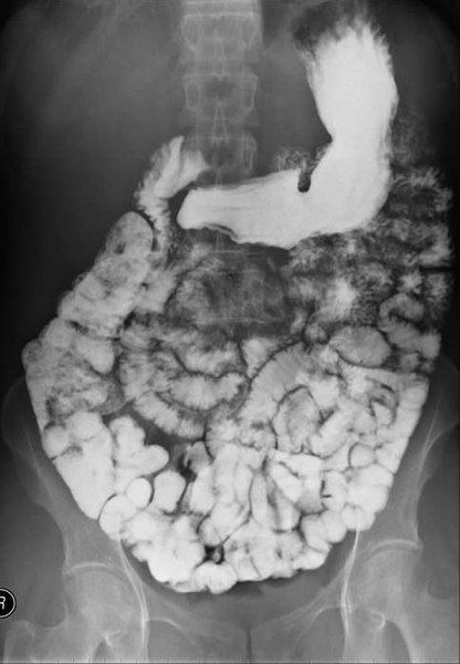 File:Smallbowel.jpg