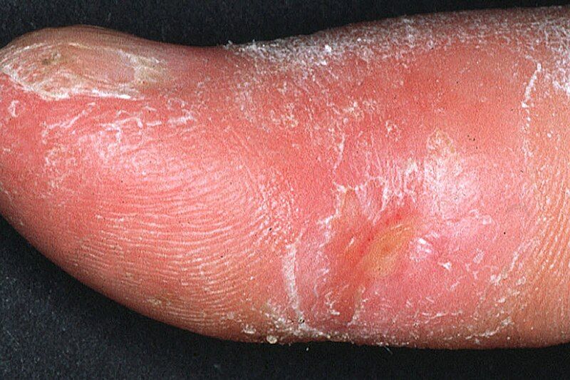 File:Systemic sclerosis finger.jpg