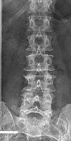 Lumbarization of S1, frontal view