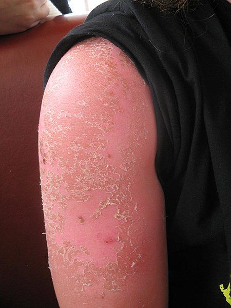 File:Sun burn.JPG