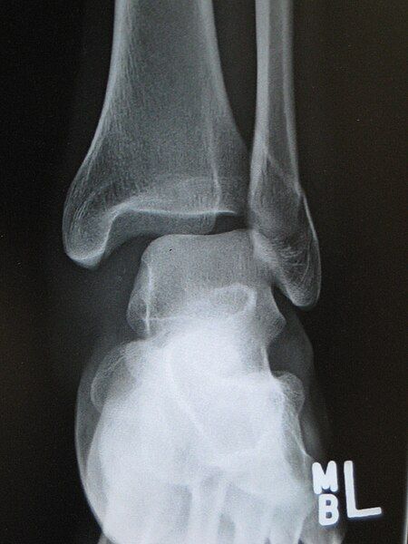 File:AnkleFractureDislocation2008.jpg