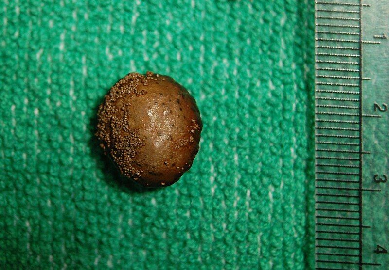 File:Bladder stone ruler.jpg