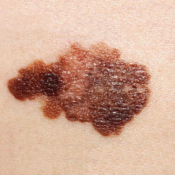 File:Melanoma (2).jpg