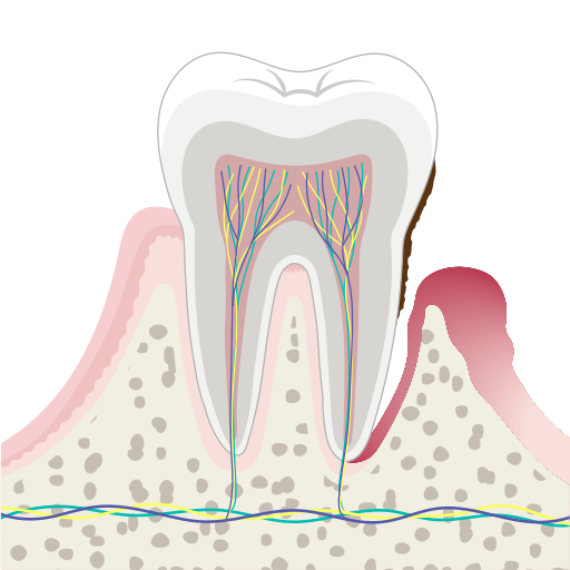 File:202402 Periodontal Disease.svg