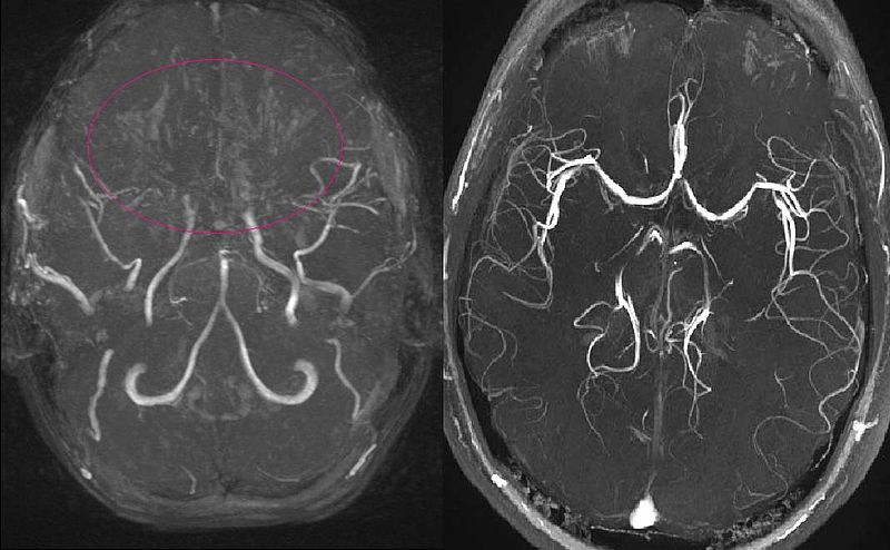 File:MRA Moya-moya-disease.JPG