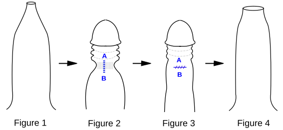 File:Preputioplasty.svg