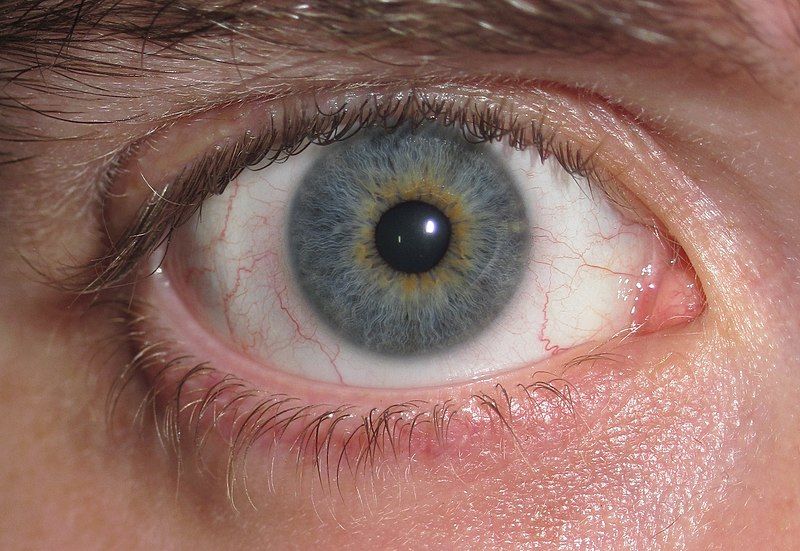 File:Eye Central Heterochromia.jpg