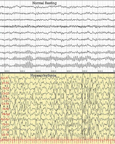 File:Human EEG Comparison.jpg