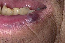 A small blue- to purple-colored lesion on the lower lip of an adult