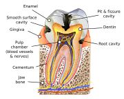 Blausen 0864 ToothDecay