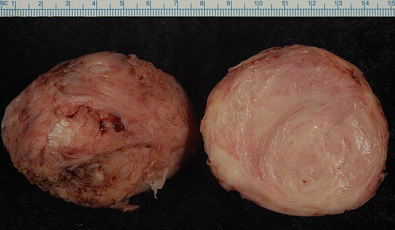 File:Leiomyoma.jpg