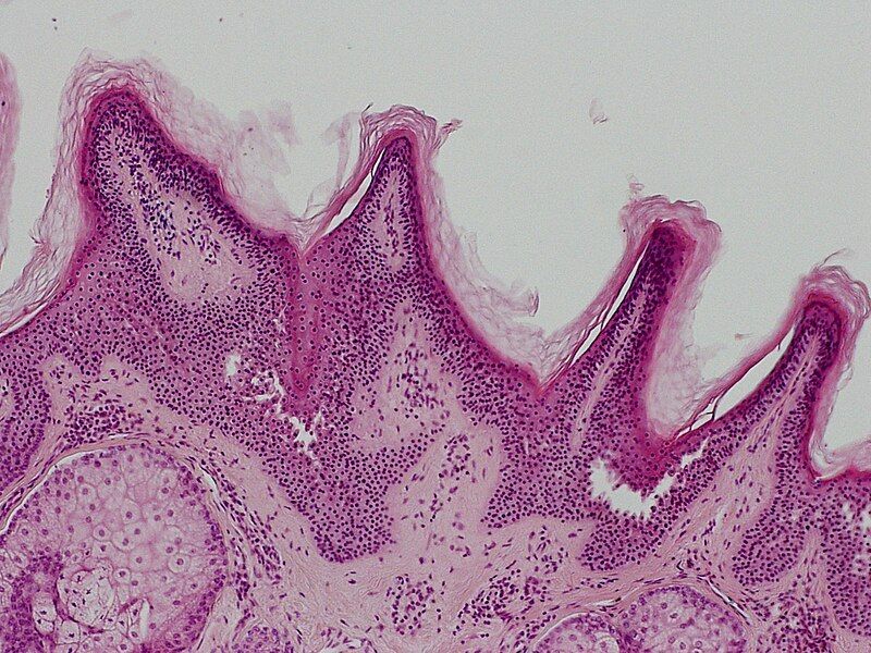 File:SkinTumors-P5280048.JPG