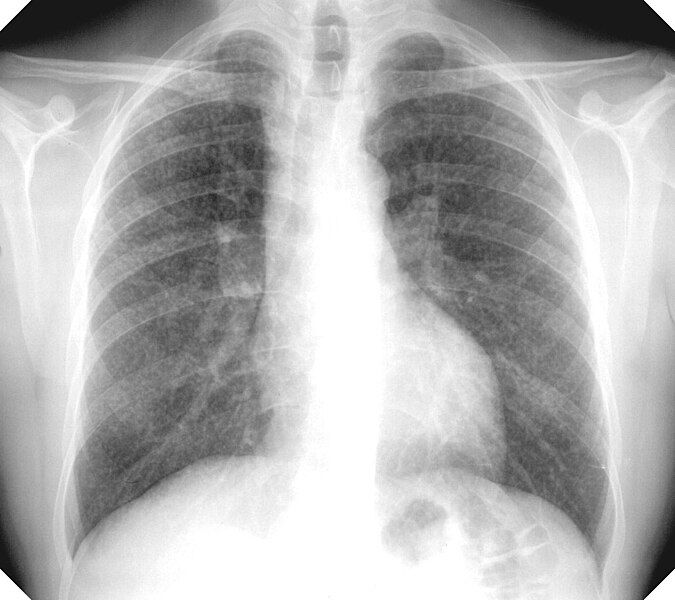 File:Silicosis simple.jpg