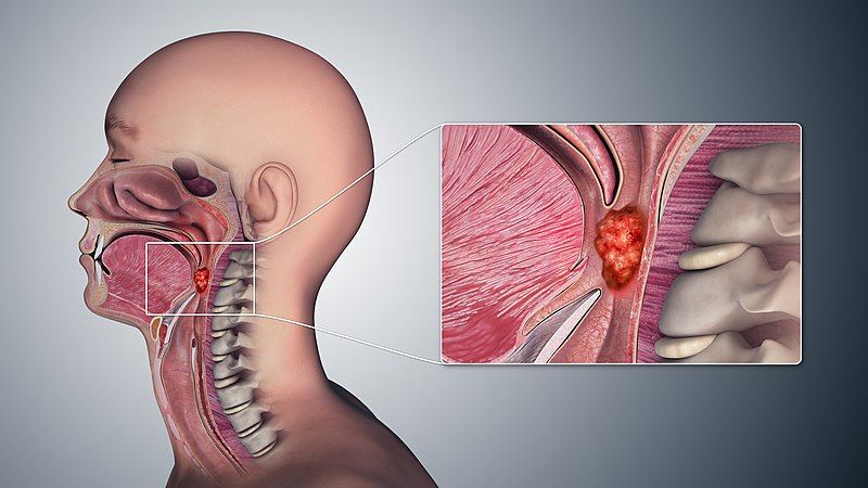 File:Oropharyngeal Cancer.jpg