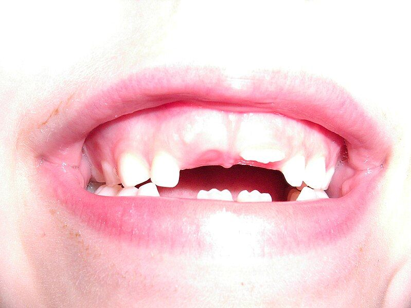 File:Deciduous teeths.jpg