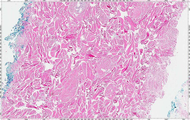 File:NuchalFibroma.jpg