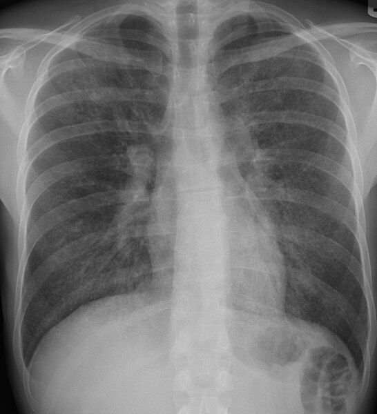 File:PCP CAP CXR.JPG