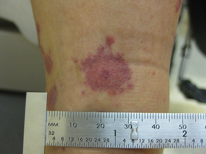 File:Target lesion 1.jpg