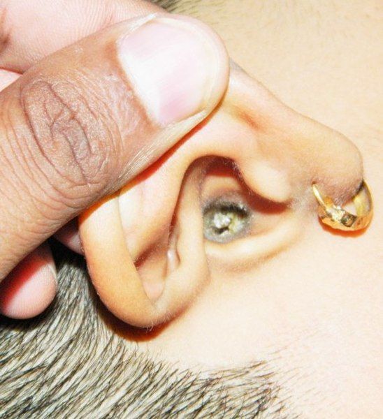 File:Ear Wax.JPG