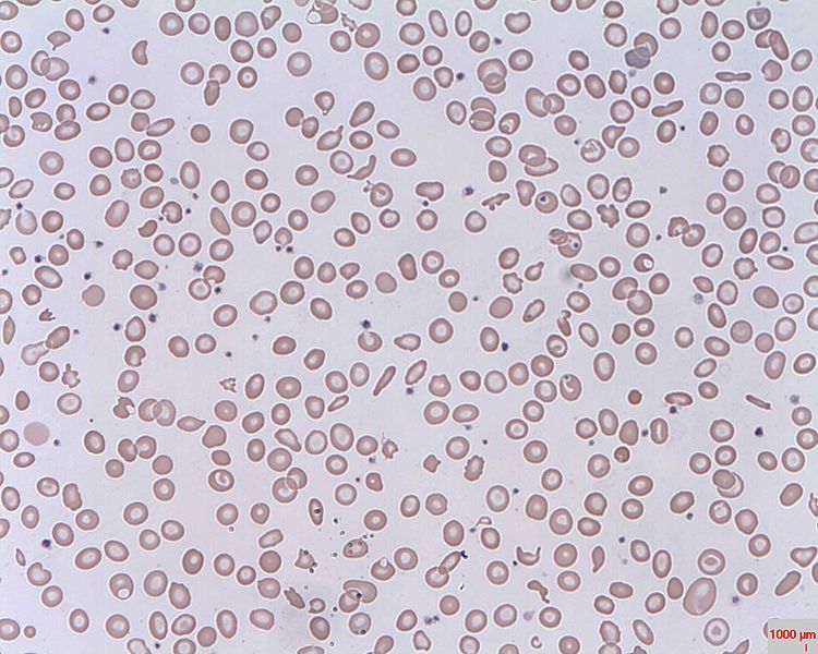 File:Schistocytes.jpg