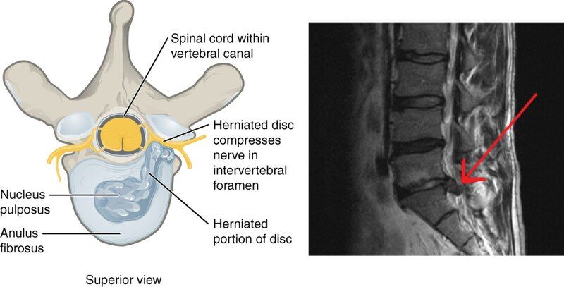 File:728 Herniated Disk.jpg