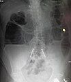 Upright abdominal X-ray of a patient with a large bowel obstruction showing multiple air fluid levels and dilated loops of bowel.