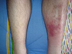 Cellulitis