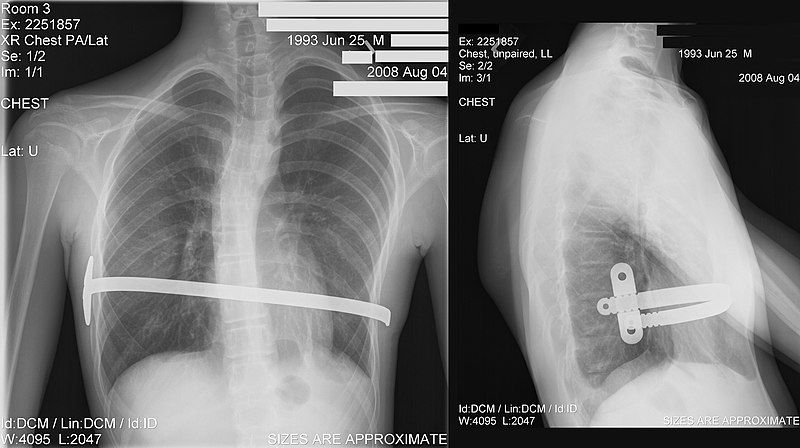 File:Nuss x-ray.jpg