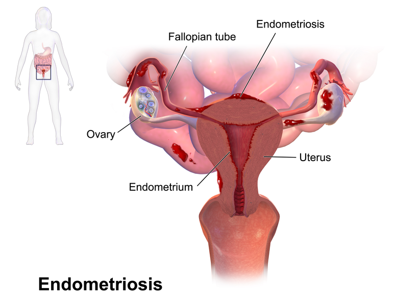 File:Blausen 0349 Endometriosis.png