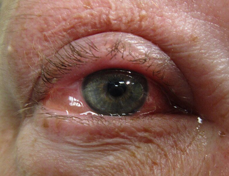 File:Allergicconjunctivitis.jpg