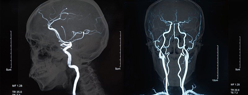 File:Magnetic Resonance Angiography.jpg