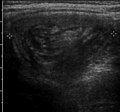 Intussusception