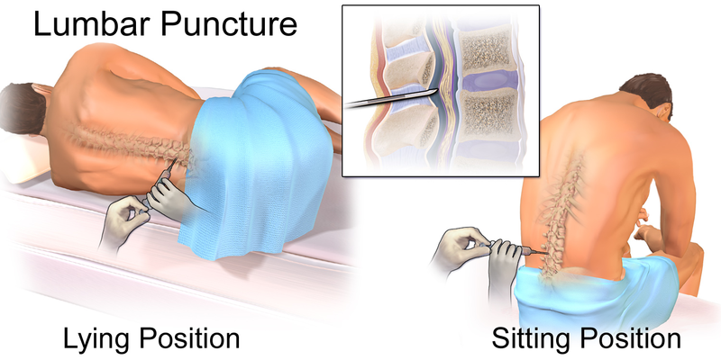 File:Blausen 0617 LumbarPuncture.png