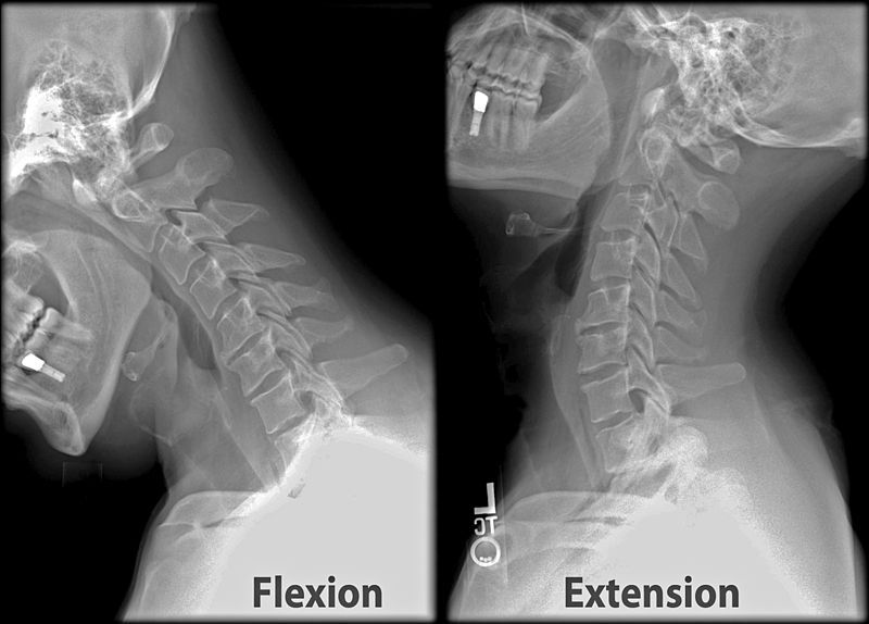 File:Cervical XRayFlexionExtension.jpg