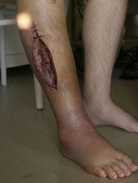 File:Fasciotomy leg.jpg