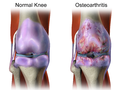 Osteoarthritis