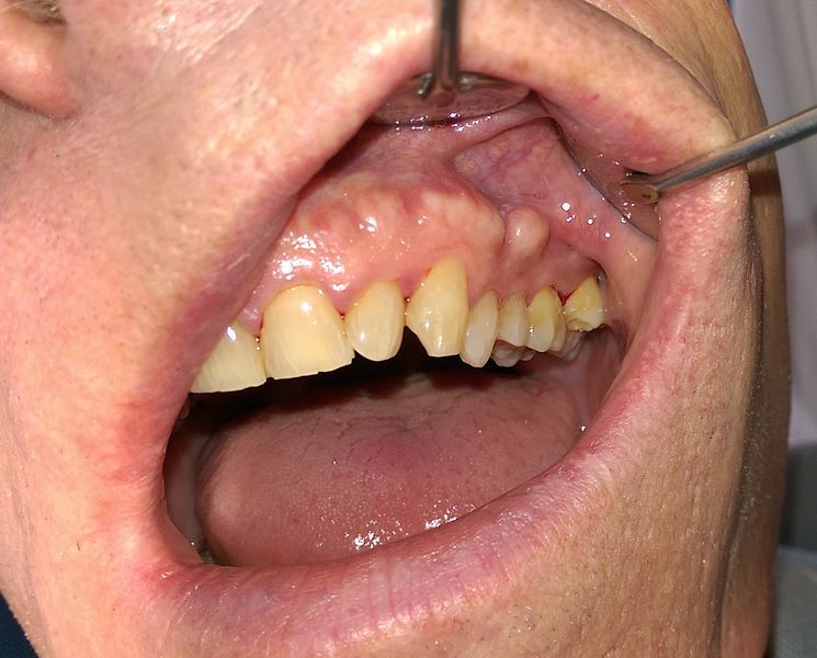 File:Buccal exostosis.jpg