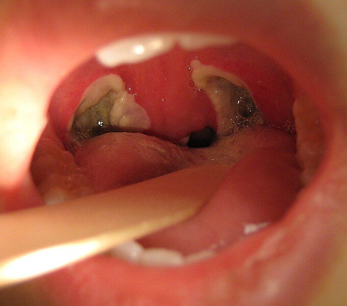 File:Tonsillectomy09.jpg