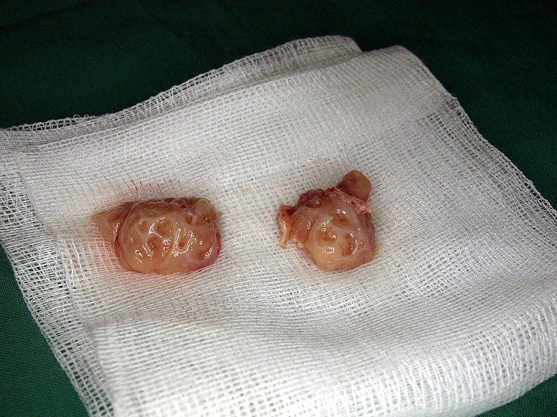 File:Tonsils.jpg