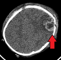 An intraparenchymal bleed with overlying skull fracture from abusive head trauma