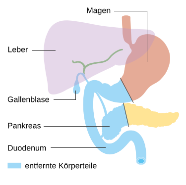 File:Diagramm Whipple Pankreasteilresektion.svg