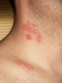 My neck and shoulder, with shingles