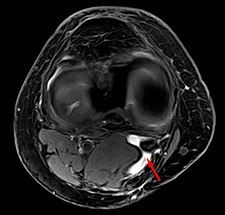 Baker's cyst on axial MRI with communicating channel between the semimembranosus muscle and the medial head of the gastrocnemius muscle.