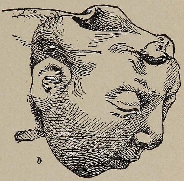 File:Anencephaly.jpg