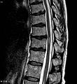 Transverse myelitis