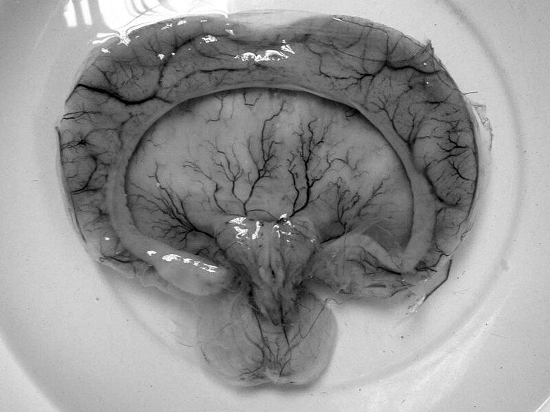 File:Alobar holoprosencephaly.jpg