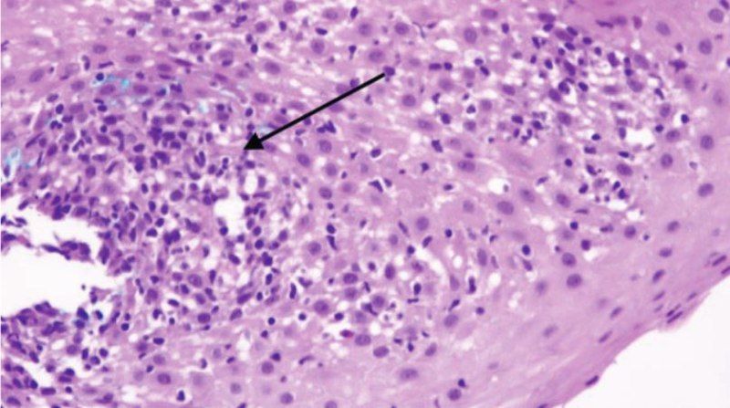 File:Lymphocytic esophagitis histology.jpg